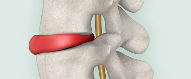 Bandscheibenvorfall: Ursachen, Symptome, Behandlung & mehr