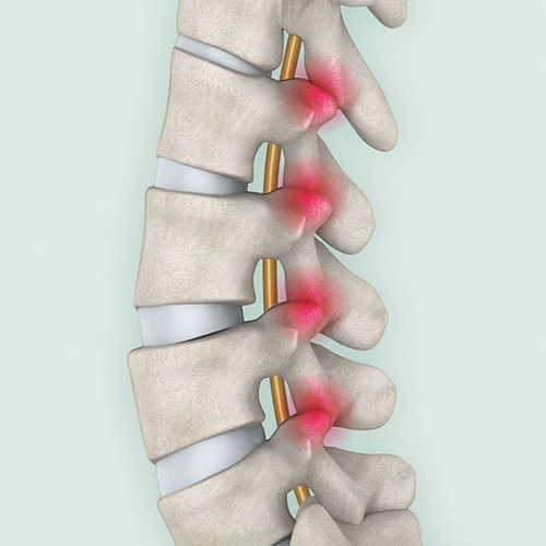 Facetten-<br>syndrom</br>