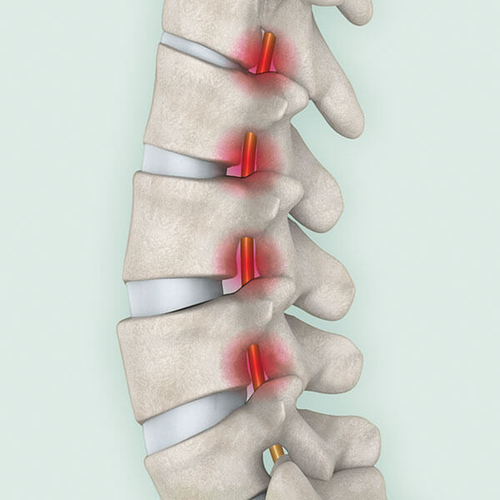 Spinalkanal-<br>stenose</br>