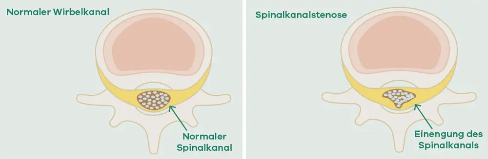 Darstellung der Spinalstenose als Einengung der Nerven